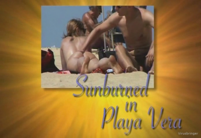 Itsmee sunburned in playa vera